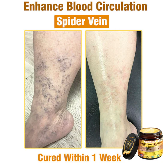 South Moon Bee Venom Pain Relief Cream for Arthritis, Muscle & Joint Discomfort (Original) zambeel